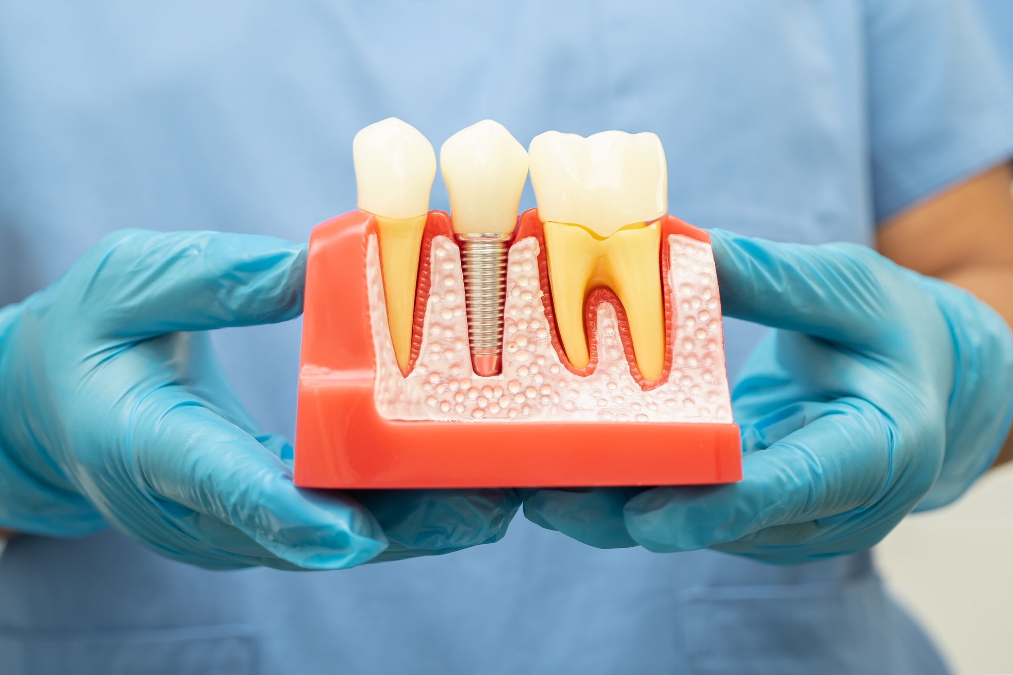 Dental implant, artificial tooth roots into jaw, root canal of dental treatment, gum disease